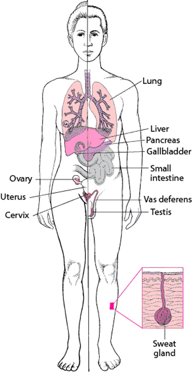 Fibrosis kistik Bukan Hanya Penyakit Paru