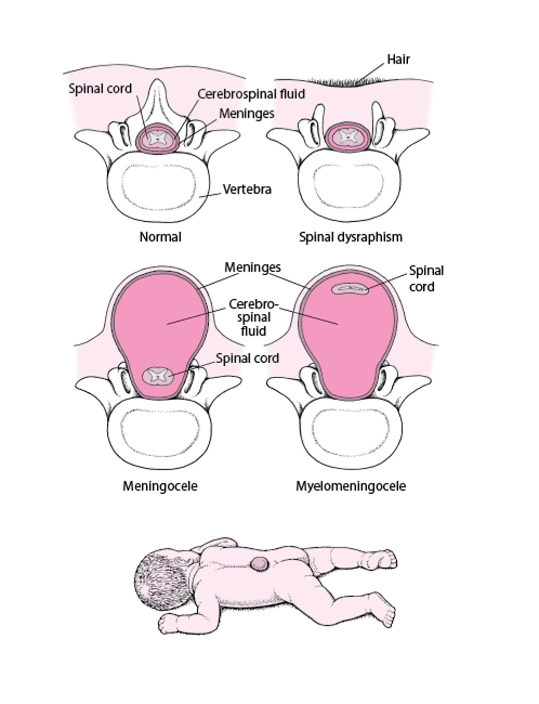 Spina Bifida: A Defect of the Spine