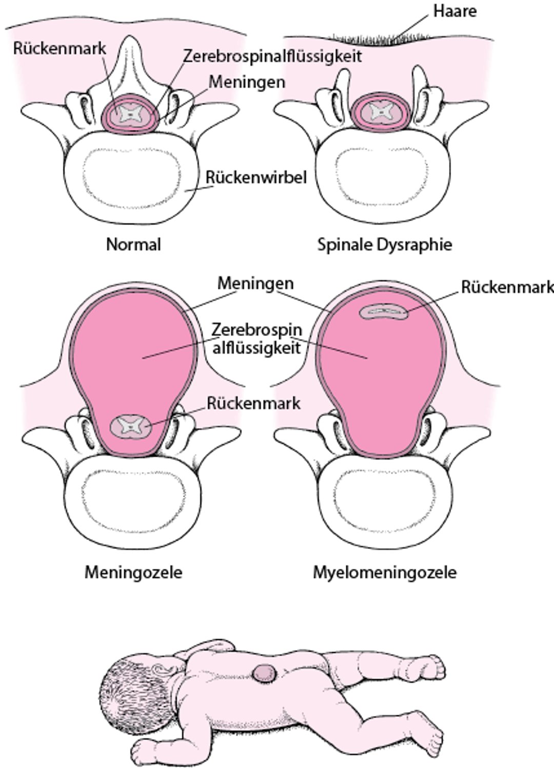 Spina bifida: Eine Fehlbildung der Wirbelsäule