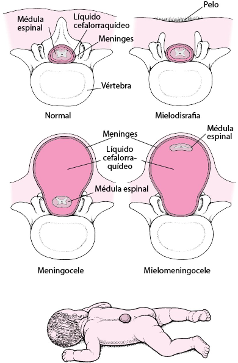 Espina bífida: defecto de la columna vertebral