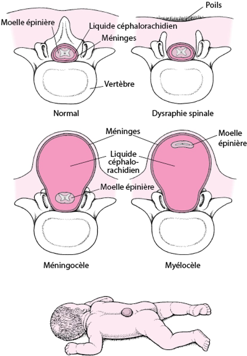 Spina bifida : une malformation du rachis