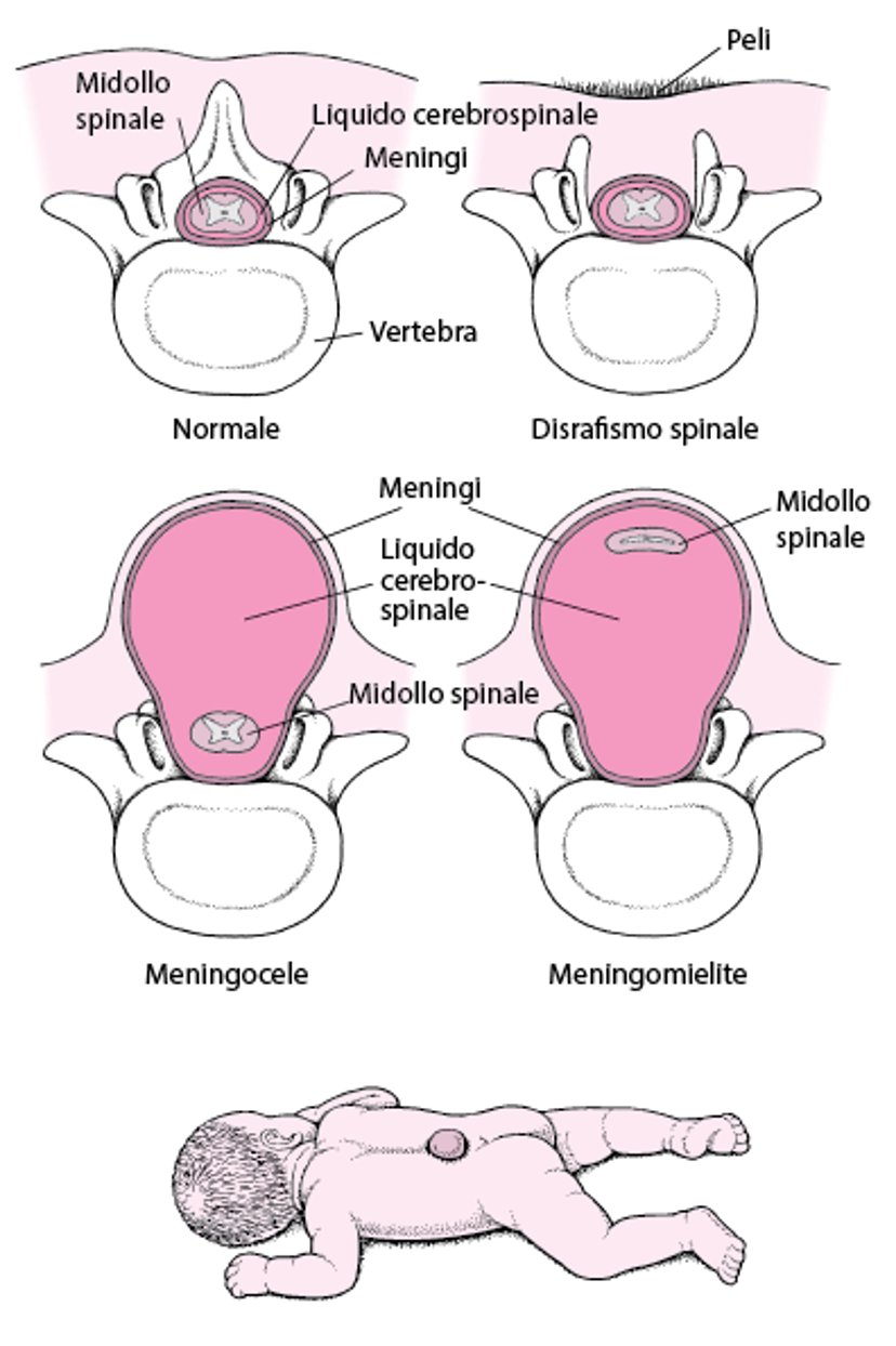 Spina bifida: difetto della colonna vertebrale