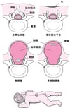 二分脊椎にぶんせきつい：脊椎せきついの異常いじょう