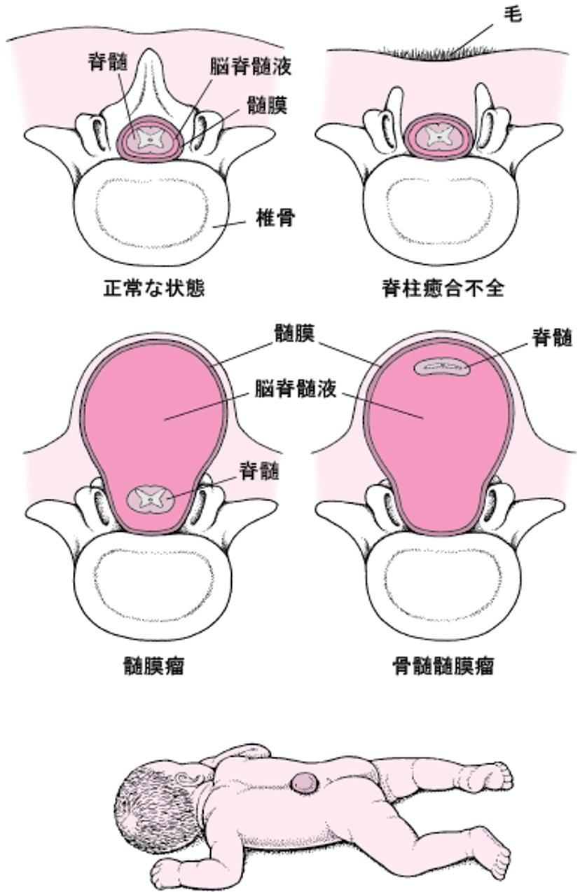 二分脊椎にぶんせきつい：脊椎せきついの異常いじょう