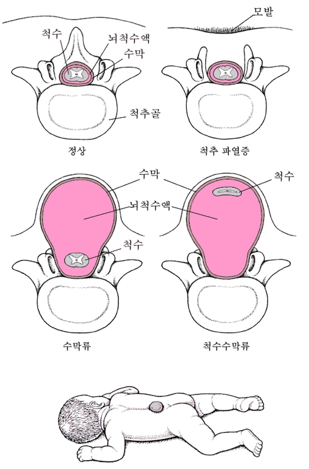 척추 이분증: 척추의 결함