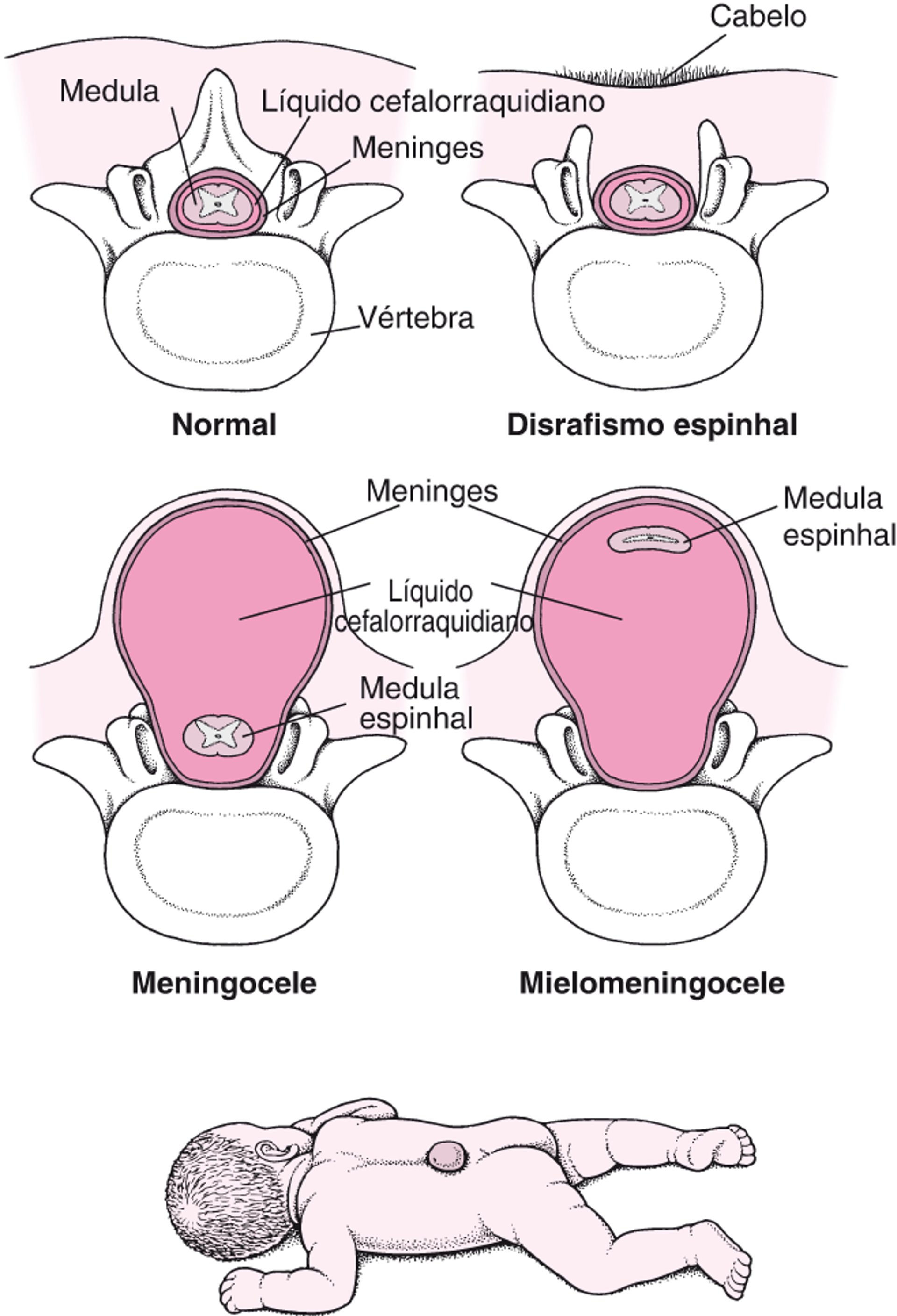 Espinha bífida: um defeito da coluna