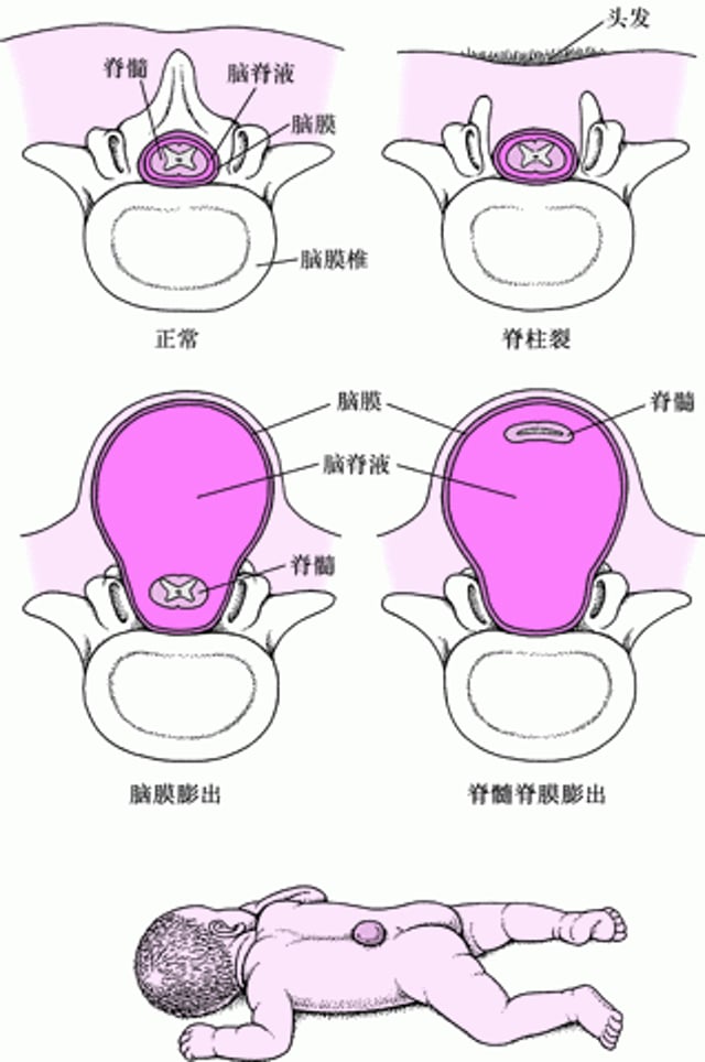 脊柱裂：一种脊柱缺陷