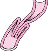 ¿Qué es la invaginación intestinal o intususpección?