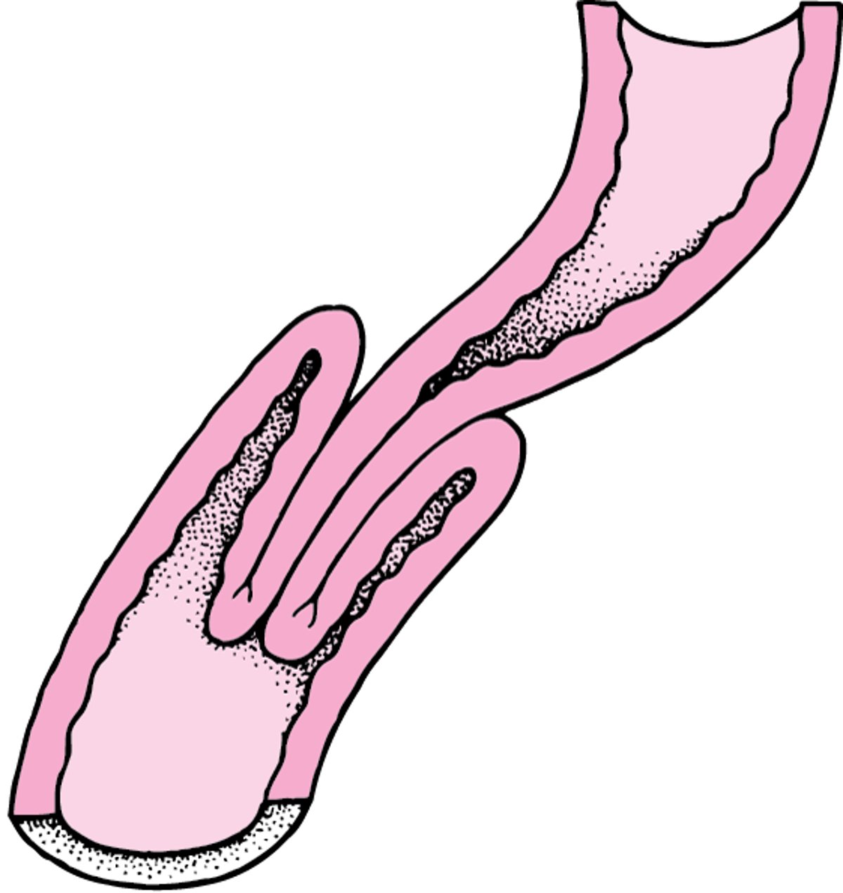 腸重積ちょうじゅうせきとは