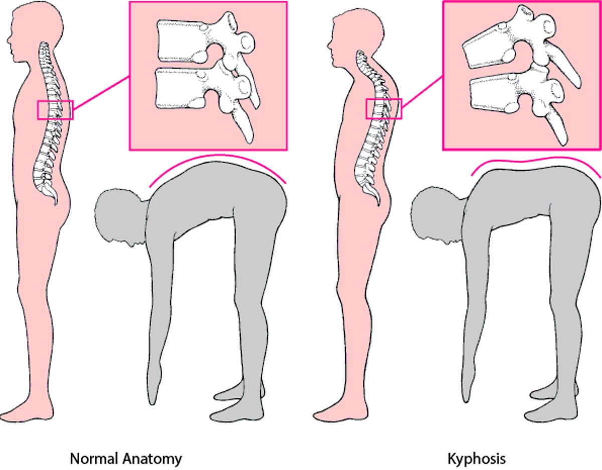 Kyphosis: A Humpback