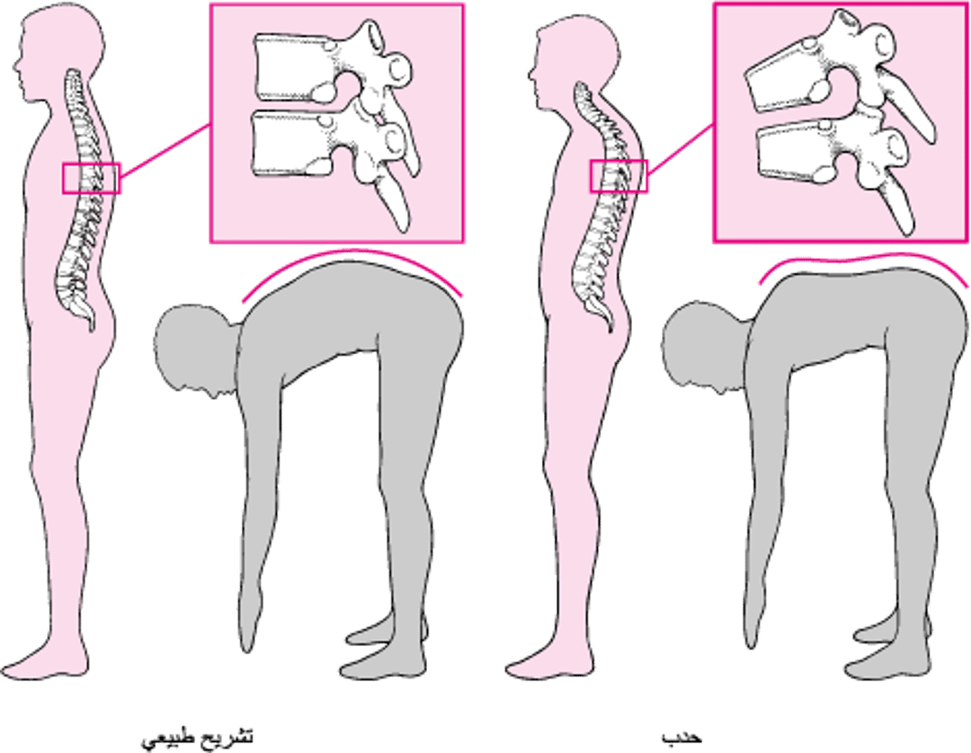 الحداب: الحَدبة Humpback