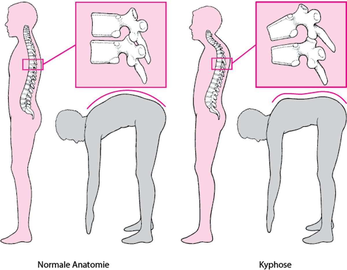 Kyphose: Ein Buckel