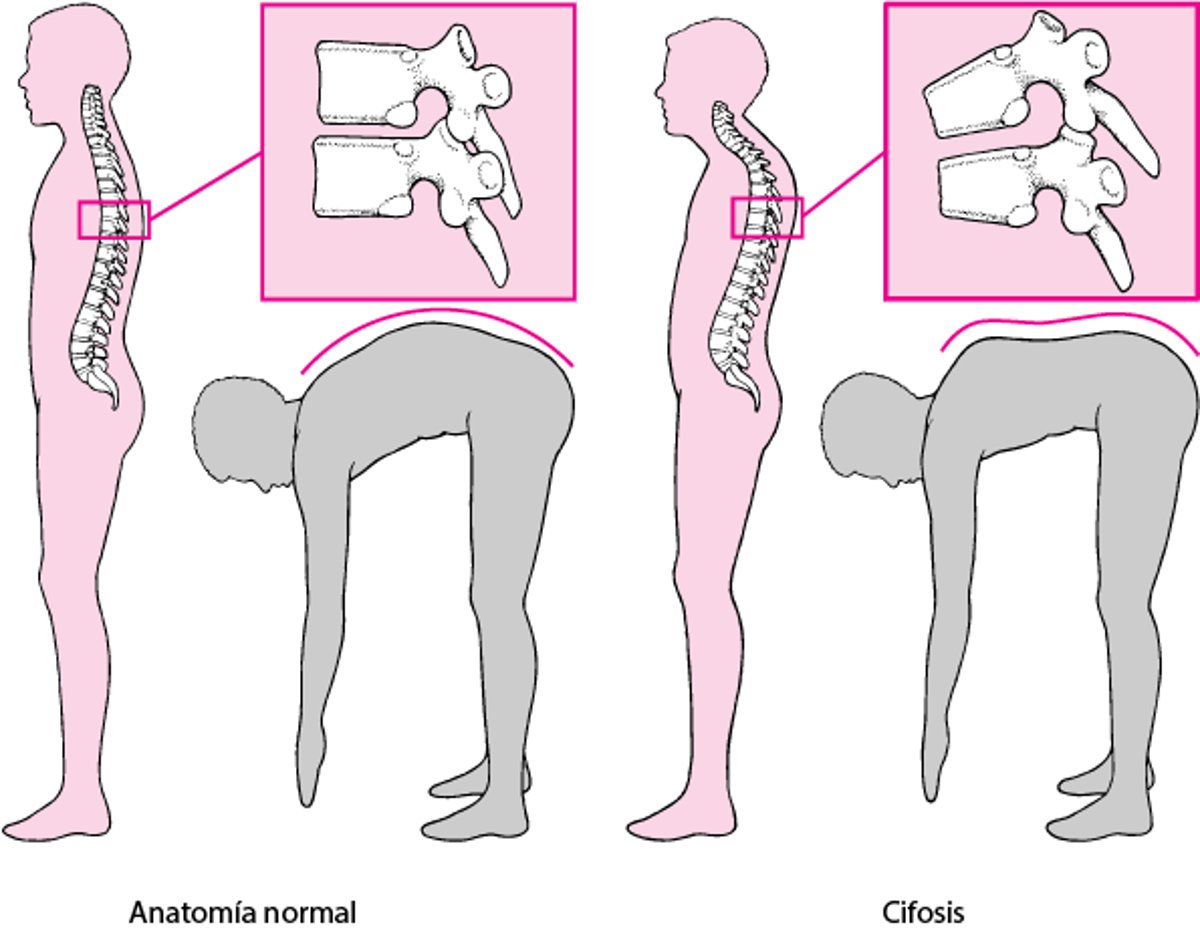 Cifosis: joroba