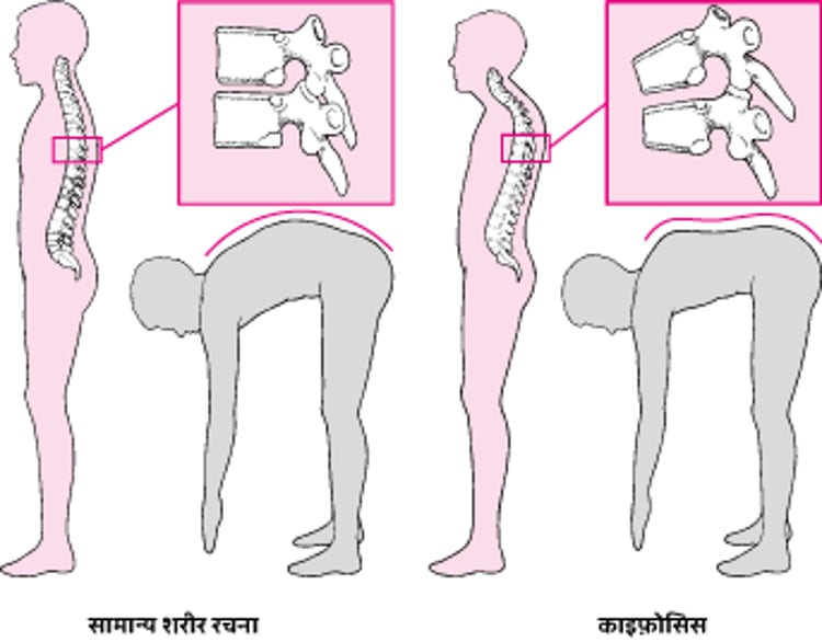 काइफ़ोसिस: हंपबैक