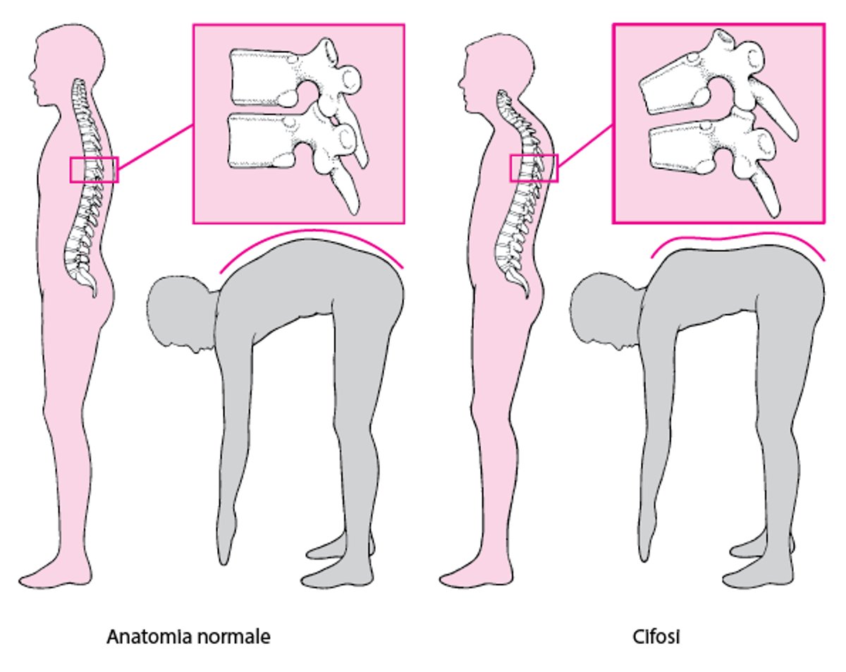 Cifosi: Schiena incurvata