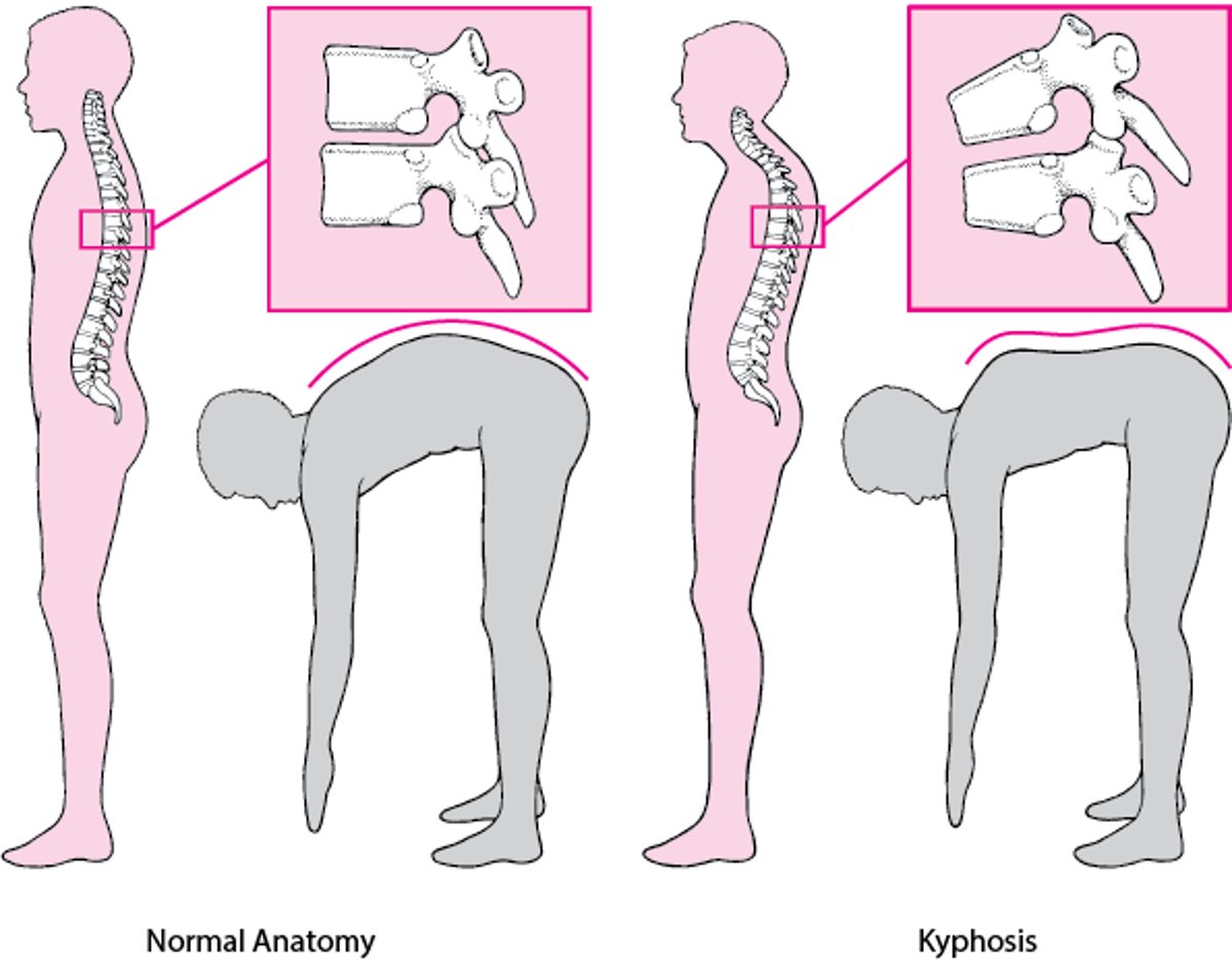 脊柱後弯症：脊柱後弯（猫背）