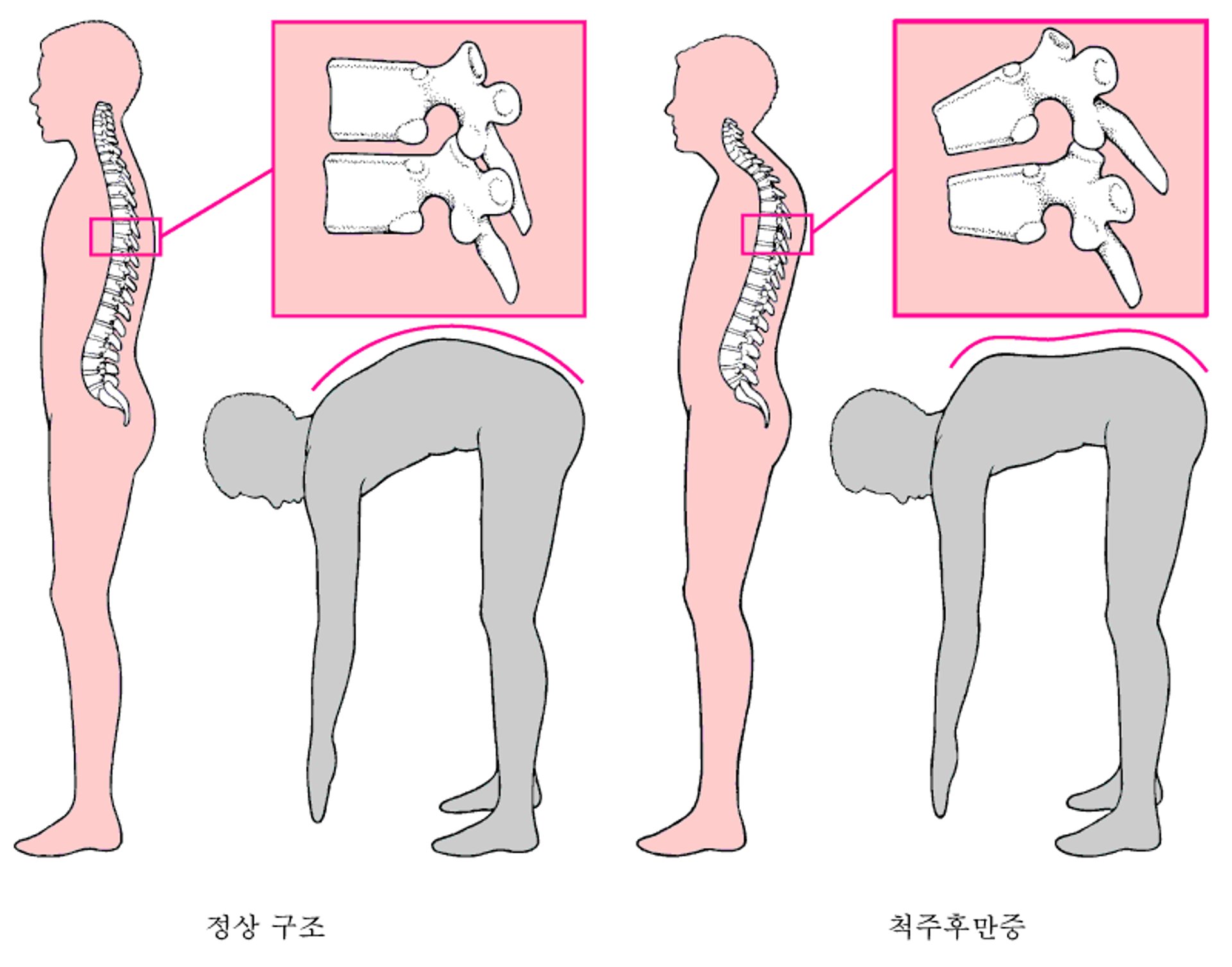 척추후만증: 꼽추