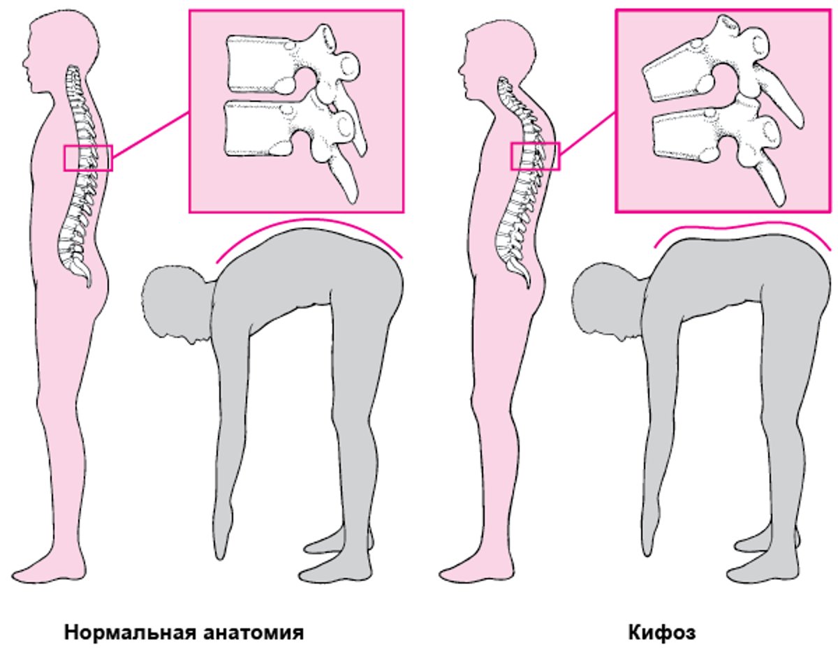 Кифоз: Горб