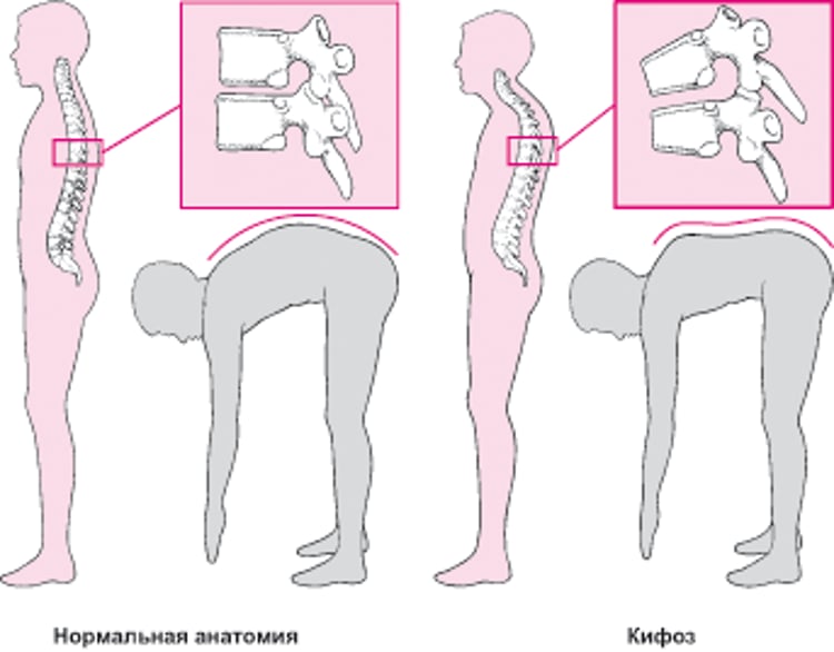 Кифоз: Горб