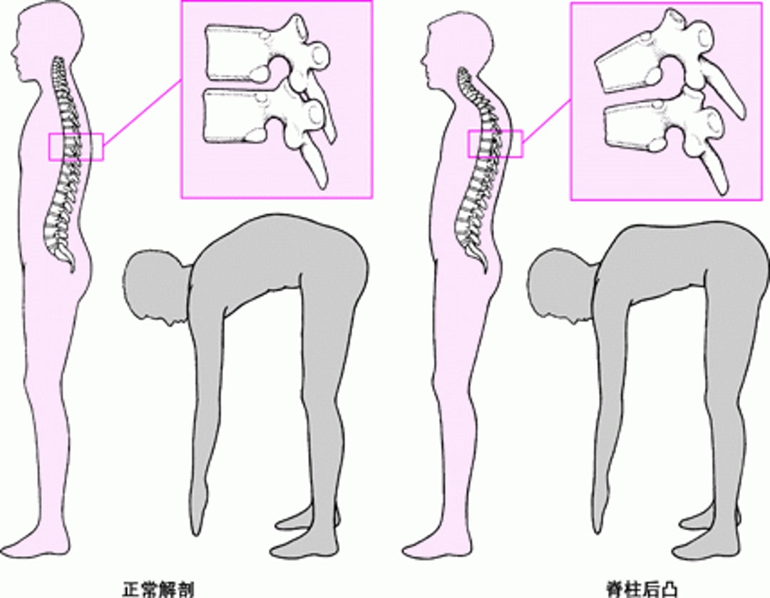脊柱后凸：驼背