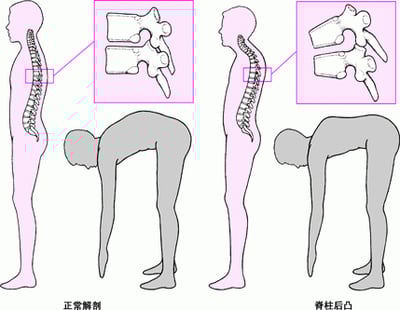 脊柱后凸：驼背