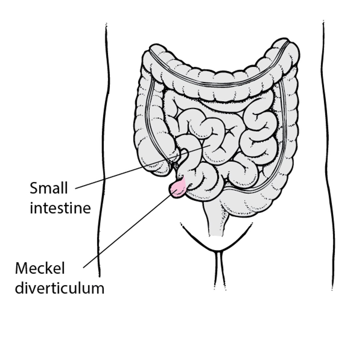 Divertículo de Meckel