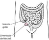 Diverticule de Meckel