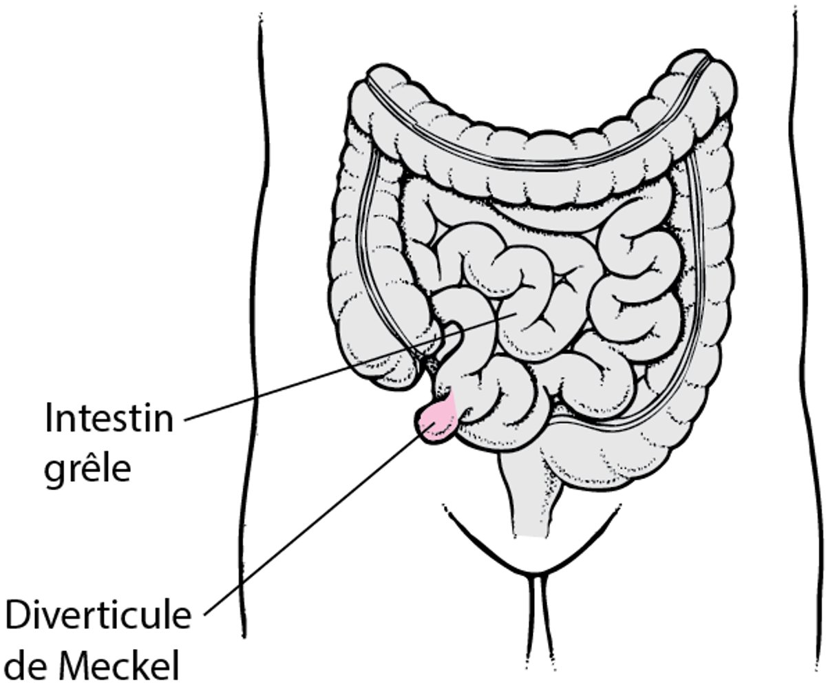 Diverticule de Meckel