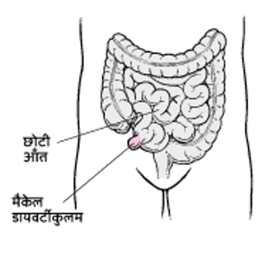 मैकेल डायवर्टीकुलम