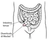 Diverticolo di Meckel