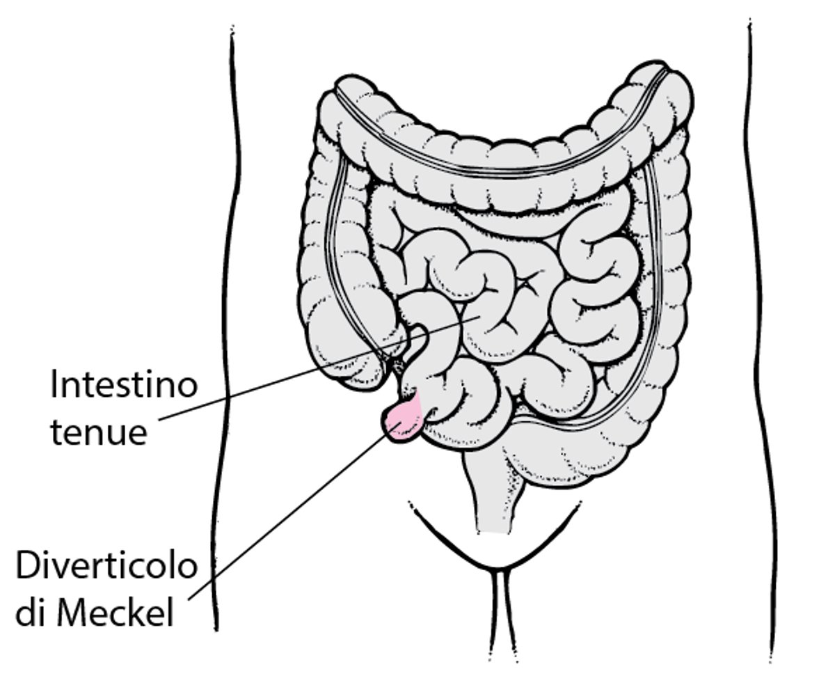 Diverticolo di Meckel