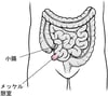 メッケル憩室けいしつ