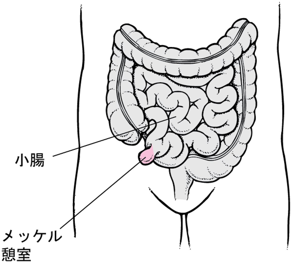 メッケル憩室けいしつ