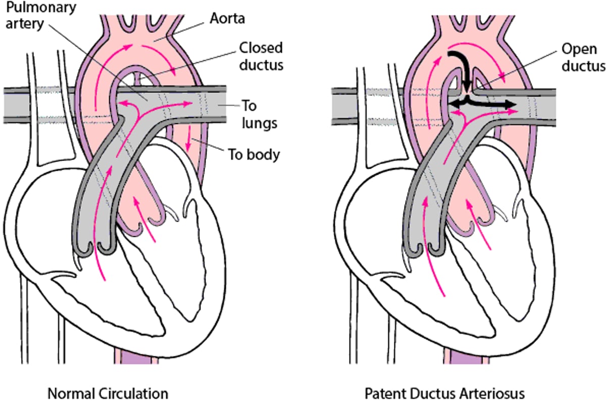 Patent Ductus Arteriosus: Failure to Close