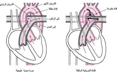 القناة الشريانية السالكة: الفشل في الانغلاق