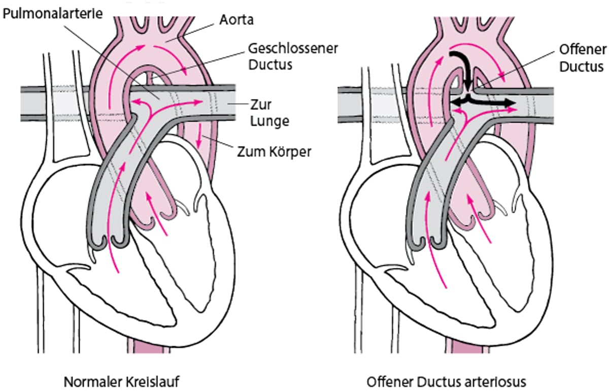 Persistierender Ductus arteriosus: Nicht geschlossene Öffnung