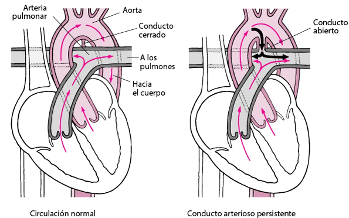 Conducto arterial persistente: defecto de cierre