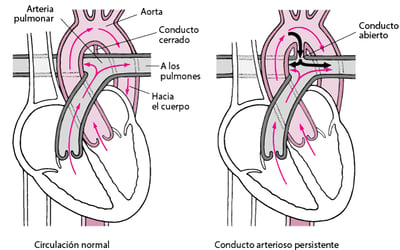 Conducto arterial persistente: defecto de cierre