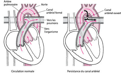 Persistance du canal artériel : défaut de fermeture