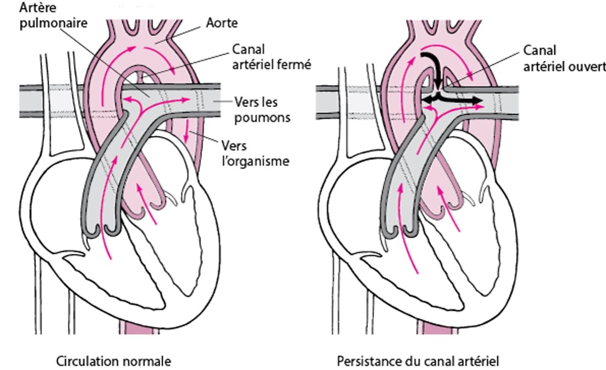 Persistance du canal artériel : défaut de fermeture