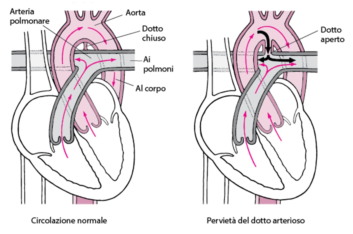 Pervietà del dotto arterioso: mancata chiusura