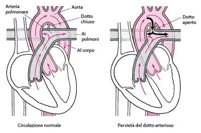 Pervietà del dotto arterioso: Mancata chiusura