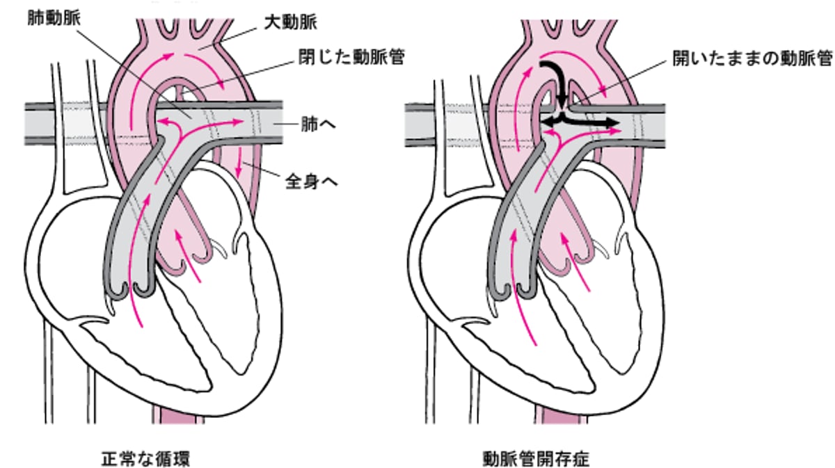 <ruby >動脈管開存症<rt >どうみゃくかんかいぞんしょう</rt></ruby>：<ruby >閉鎖<rt >へいさ</rt></ruby><ruby >不全<rt >ふぜん</rt></ruby>