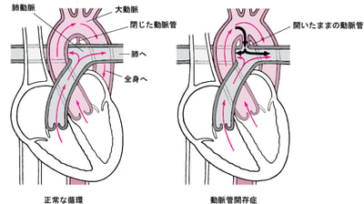 動脈管開存症：閉鎖不全