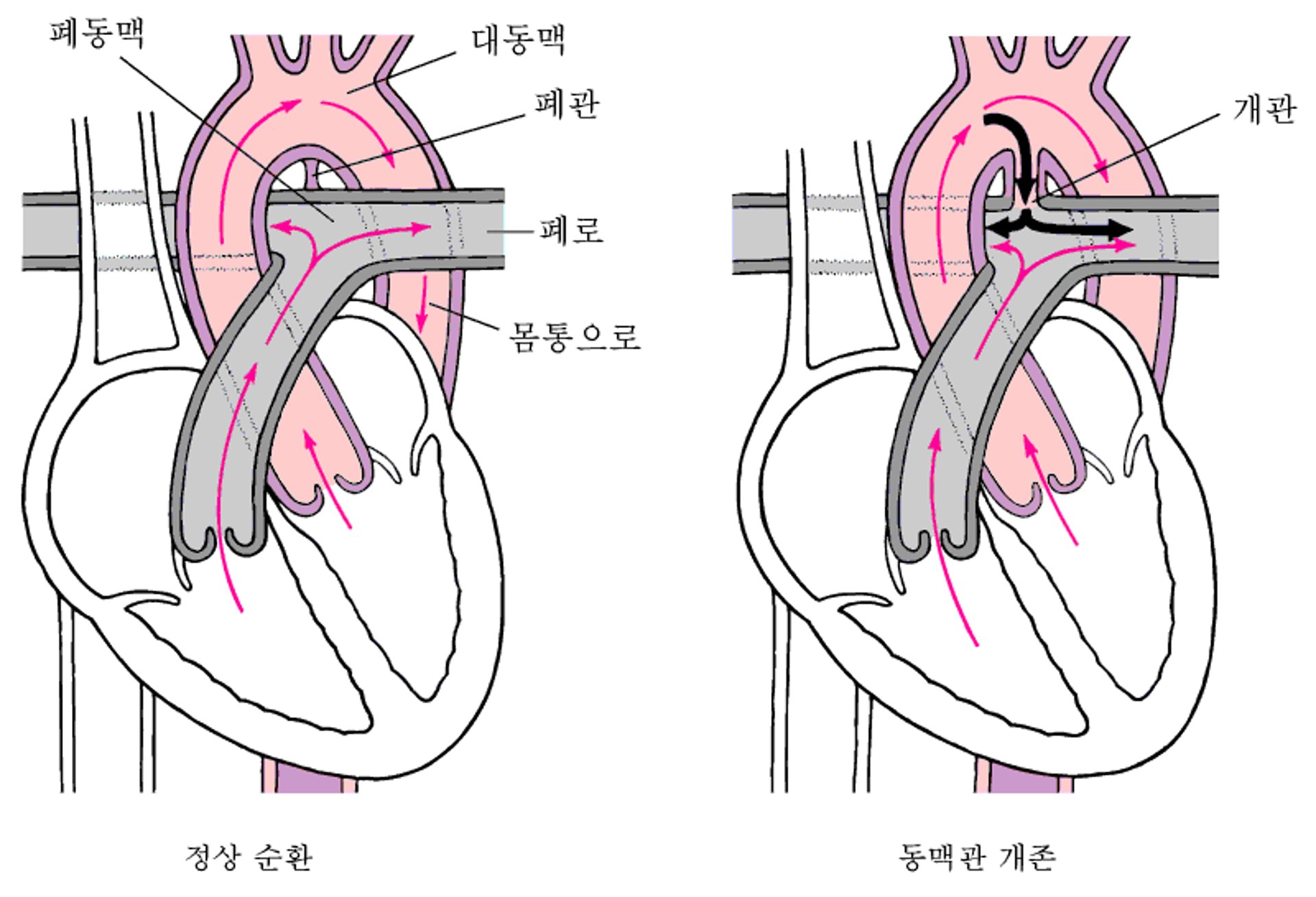 동맥관 개존: 폐쇄할 수 없음