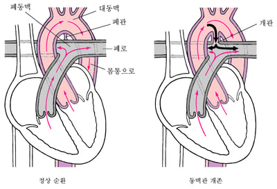 동맥관 개존: 폐쇄할 수 없음