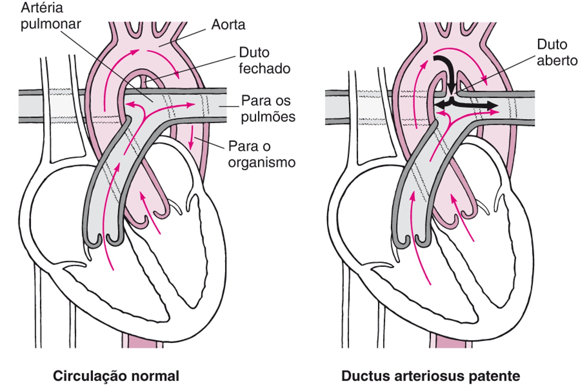 Duto arterioso patente: O duto não fecha