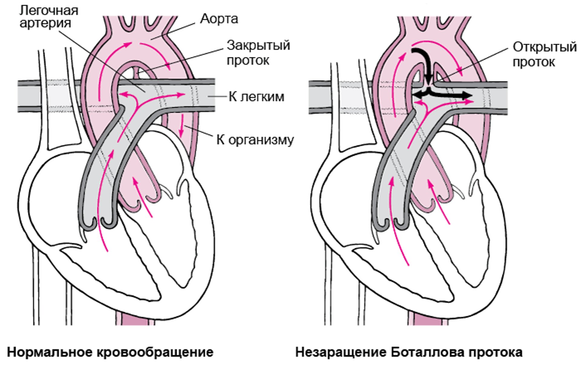 Незаращение боталлова протока: неспособность закрыться