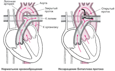 Незаращение боталлова протока: неспособность закрыться