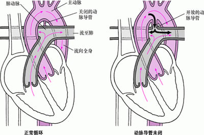 动脉导管未闭：无法关闭